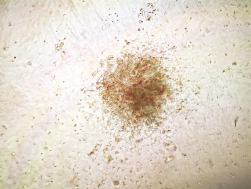 Zellkolonie aus mit der Genschere reparierten menschlichen blutbildenden Stammzellen. Nur die reparierten Stammzellen konnten eine solche Kolonie bilden.