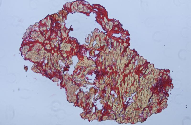 Histologie eines humanen Herzschnitts mit mehr als 40 Prozent fibrotischer Fläche; Kollagenanreicherungen, als Zeichen einer Fibrose, sind rot gefärbt.