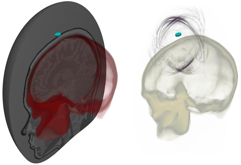 Links: Ein hexaedrisches Finite-​Elemente-Netz des Schädels und des Gehirns. Rechts: Eine Momentaufnahme der resultierenden Ultraschallsimulation. Die blaue Scheibe in beiden Bildern repräsentiert die Ultraschallquelle. 