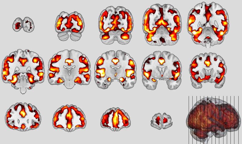 Neuroanatomische Muster der Schizophrenie  
