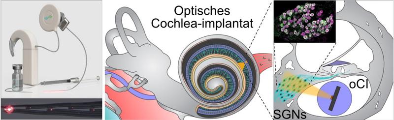 Abbildung: Links: Konzeptzeichnung der Kombination von optischem Cochlea-Implantat (oCI) mit Gentherapie-Produkt (oben), Nahaufnahme eines Wellenleiter-basierten oCI-Prototypen zur Anregung mit rotem Licht (unten). 