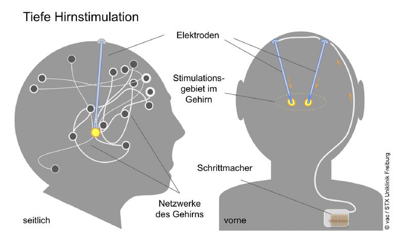 Bei der Tiefen Hirnstimulation werden haarfeine Elektroden in einen bestimmten Bereich des Gehirns geschoben. Über ein dünnes Kabel sind sie mit einer Batterie im Brustraum verbunden.