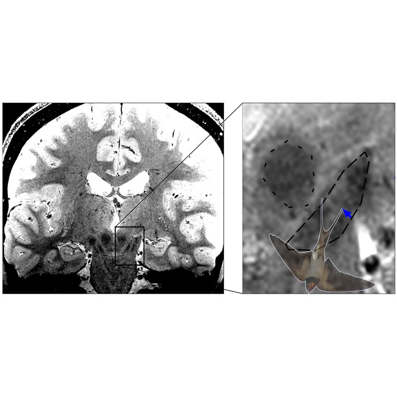 With high-resolution MRI imaging it is possible to image the swallow-tail sign, which is located in the posterior third of the substantia nigra.