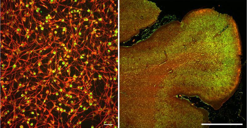 Links: In-vitro Kultur (scale = 50 µm) von induzierten Neuronen (rot) von Alzheimer-Patienten enthalten viel PKM2 (grün). Rechts: PKM2 (grün) wird auch in Neuronen (rot) im post-mortem Gehirn von Alzheimer-Patienten gefunden