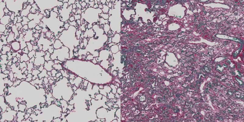 Healthy (left) and fibrotic lung tissue (right)