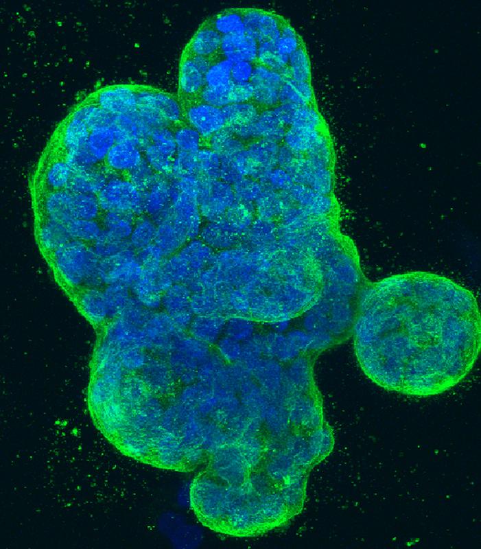 Dreidimensionale Kultur menschlicher Brustkrebszellen, mit blau gefärbter DNA und einem grün gefärbten Protein in der Zelloberflächenmembran.