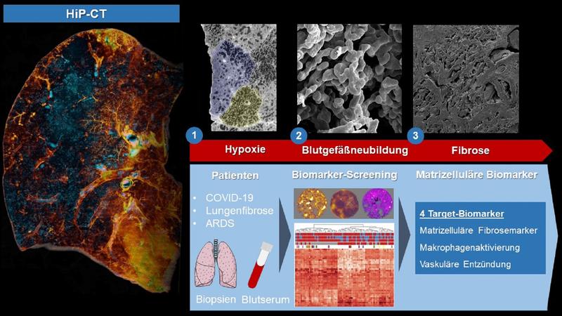 Mithilfe der HiP-CT konnte erstmalig gezeigt werden, dass es bei schweren COVID-19-Verläufen zu einer mosaikartigen hypoxischen Minderversorgung der kleinsten funktionellen Einheit der Lunge, den Lungenlobuli, kommt. 