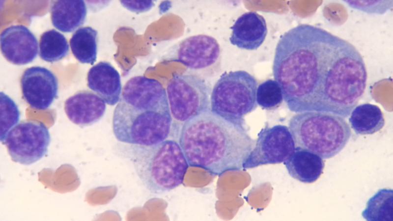 Myelomzellen in unterschiedlicher Ausreifung (blau/violett) in einem Knochenmarkausstrich