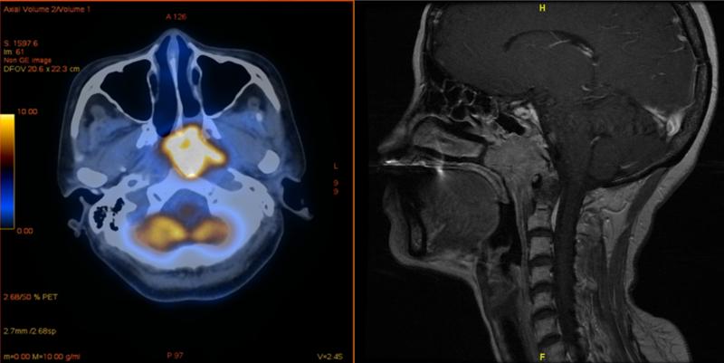 Nasenrachentumore (gelb markiert) sind in Ländern Südostasiens eine häufige Erkrankung. Die Sorge, die Therapie könne ungünstig mit einer Covid-Impfung interferieren, ist aber wohl unbegründet. 