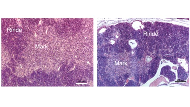 Die klare Unterscheidung von Rinde und Mark des normalen Thymus (linke Bildhälfte) ist bei Mutation im GTF2I-Gen aufgelöst (rechte Bildhälfte)und zeigt sich in einer zerklüfteten Gewebsstruktur.