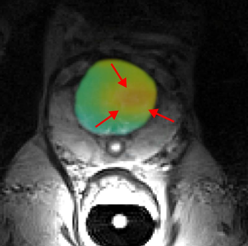 Bislang lassen sich im MRT-Bild (grau) die Organe erkennen. Im Bereich der Prostata ist farblich der Stoffwechsel des Moleküls Pyruvat dargestellt, dessen Signal mit Hilfe der Hyperpolarisierung verstärkt wurde. auf Die Färbung deutet auf einen Tumor hin.