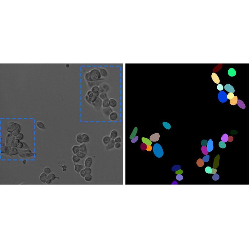 L: Mikroskop-Aufnahme von Tumor-Zellen. R: Segmentierung via gängige Computerprogramme. Sobald Zellen dicht nebeneinanderliegen oder überlappen (s. Markierung) verschlechtert sich die Segmentierung. Das vollautomatische Tracking führt zu Ungenauigkeiten.