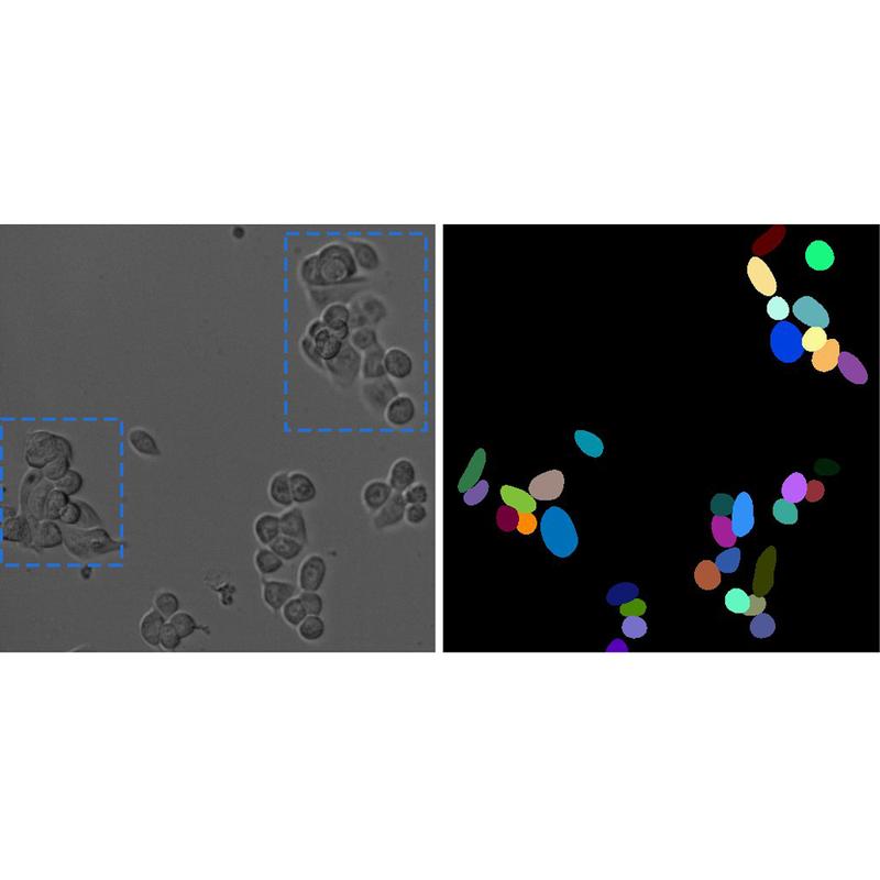 L: Microscopic image of tumor cells. R: Segmentation via common computer programs. As soon as cells are close to each other or overlap (see blue box), segmentation deteriorates. The fully automated tracking leads to inaccuracies.