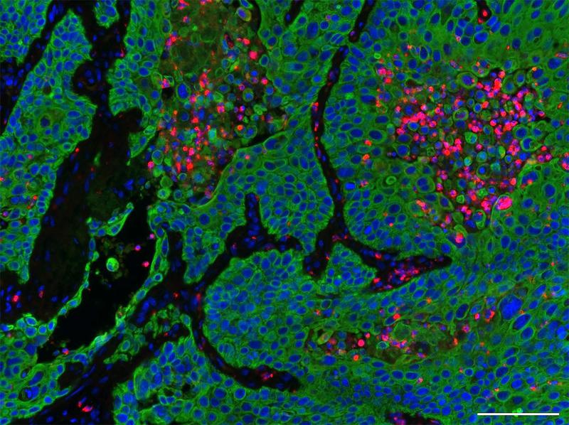 Aufnahme Fluoreszenzmikroskop: Neutrophile Granulozyten (pink), Lungenkrebs Tumore (blau und grün).