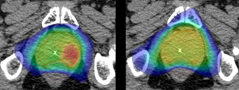 In der Hypofocal-Studie wird genau der Bereich der Prostata, in dem der Tumor sitzt (rot, links), mit hoher Intensität bestrahlt, statt wie bisher die gesamte Prostata mit niedrigerer Dosis zu bestrahlen.