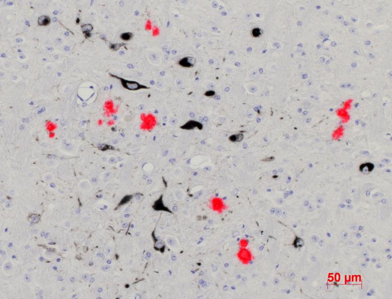 Hirngewebe einer Maus mit Alzheimer-ähnlichen Symptomen. Die Beta-Amyloid-Plaques sind rot angefärbt.