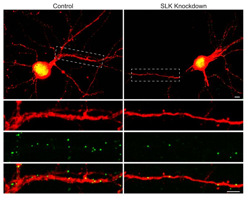 In der Nervenzelle rechts fehlt das SLK-Molekül. Dadurch verliert sie einen Teil ihrer inhibitorischen Postsynapsen (grün) - das sind die „Regler“, die die Antwort der Zelle auf einen Reiz reduzieren. 