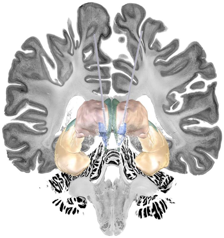 Bei Menschen mit Alzheimer-Erkrankung hat die Tiefe Hirnstimulation des neuronalen Bereichs zwischen Fornix (grün) und dem Kerngebiet der Stria terminalis (blau) die stärksten positiven Effekte gezeigt. Rosa: Thalamus, gelb: Hippocampus. 