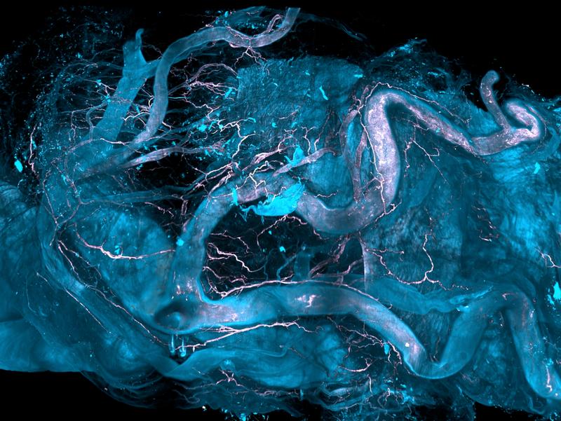 Bhatia et al. developed DISCO-MS, a 3D spatial-omics technology that uses robotics to obtain proteomics data from cells identified early in diseases. Image shows the aortic regions of a human heart whose vascular plaques are analyzed by DISCO-MS.