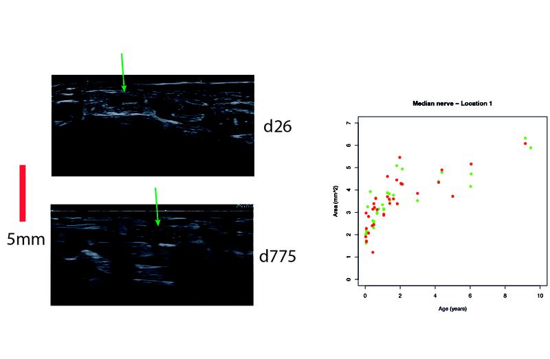 Korrelation zwischen Alter und Durchmesser des Nervus medianus in den ersten zwei Lebensjahren - Untersuchung mittels hochauflösender Ultraschalltechnik