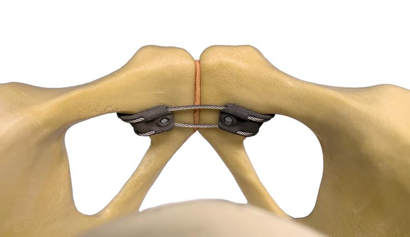 Die Titan-Klammern mit einer Führungsstruktur für das geflochtene Stahlseil werden fest am Knochen mit zwei Schrauben fixiert. Da sie fest im Implantat fassen und nicht im Knochen, können sie nicht ausbrechen. 