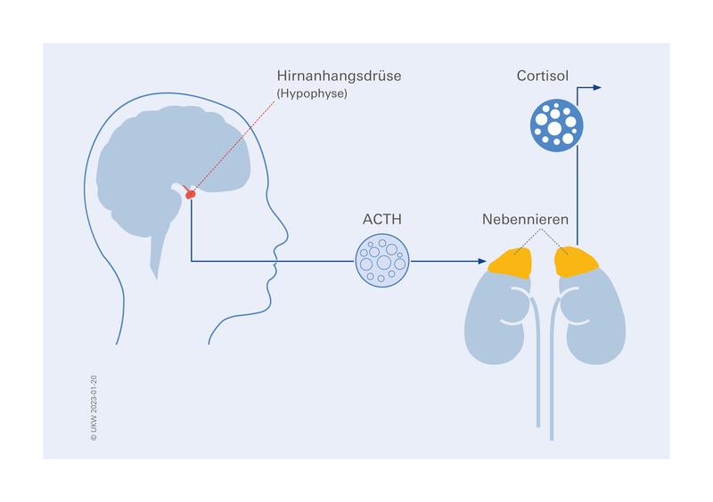 Das Cushing-Syndrom wird in den meisten Fällen durch gutartige Tumore der Hypophyse ausgelöst. Durch den Tumor produziert die Hirnanhangsdrüse ungebremst das Hormon Adrenocorticotropin (ACTH), welches die Nebennieren antreibt, Cortisol auszuschütten. 