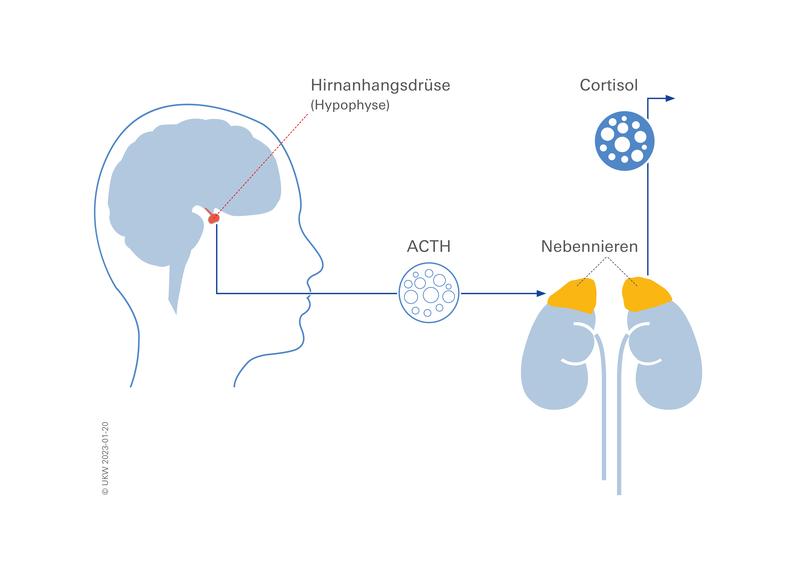 Das Cushing-Syndrom wird in den meisten Fällen durch gutartige Tumore der Hypophyse ausgelöst. Durch den Tumor produziert die Hirnanhangsdrüse ungebremst das Hormon Adrenocorticotropin (ACTH), welches die Nebennieren antreibt, Cortisol auszuschütten. 