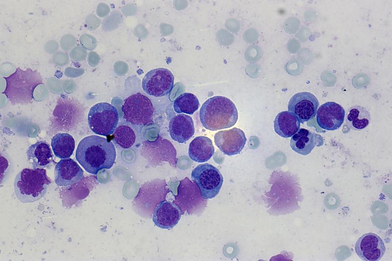 Bei der AML entartet eine frühe Vorstufe der sogenannten myeloischen Zellen, diese sogenannten Blasten (violett eingefärbt, 63-fache Vergrößerung) vermehren sich in der Folge unkontrolliert.