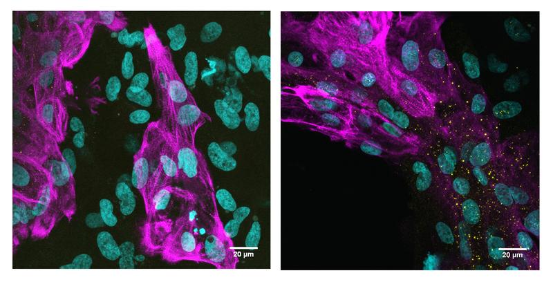Kultivierte humane Herzmuskelzellen: (links) nicht infiziert, (rechts) infiziert mit der Omicron Subvariante BA.1. Virales Spike-Protein wird in den gelben Punkten sichtbar