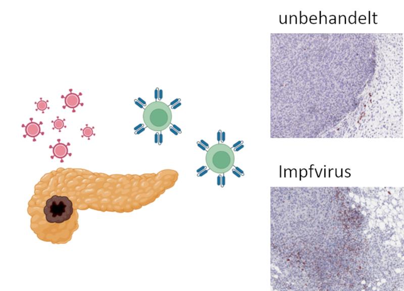 Neue Behandlung gegen Bauchspeicheldrüsenkrebs aus immun-aktivierenden Impfviren plus Immunzellen (links). Rechts: Die Impfviren bewirken, dass mehr Immunzellen (braun) in den Tumor gelangen.