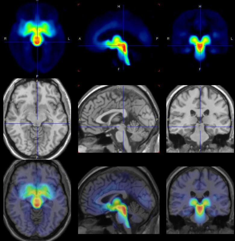 Die WissenschaftlerInnen haben zu verschiedenen Zykluszeitpunkten Aufnahmen vom Gehirn der Frauen mit Positronen-Emissions-Tomografie (PET) gemacht.