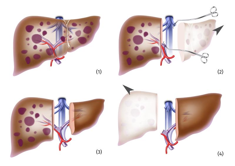 OP-Ablauf: Von der Leber mit Metastasen(1) wird zunächst nur ein Teil entfernt (2) und durch ein gesundes Teilorgan ersetzt. Geminderte Durchblutung des kranken Leberrestes lässt das Transplantat wachsen (3), der kranke Rest kann entfernt werden (4).