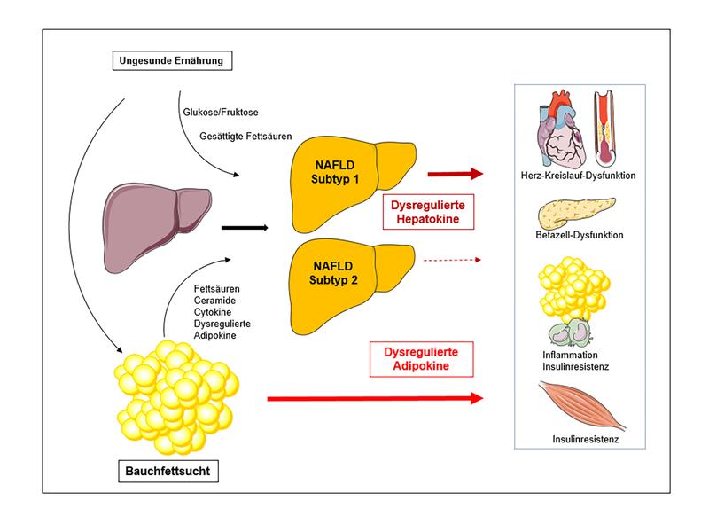 NAFLD: Rolle der Hepatokine bei der Identifizierung von Subtypen