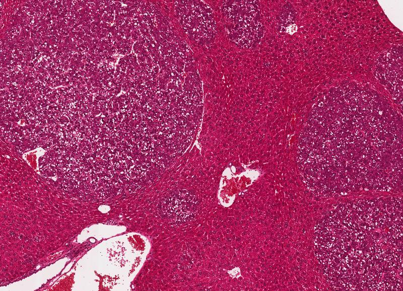 Das lichtmikroskopische Bild zeigt die Leber einer kranken Maus, in der sich viele Tumoren gebildet haben. Die Tumoren sind etwas dunkler gefärbt und grenzen sich rund vom gesunden Gewebe ab (Hämatoxylin-Eosin-Färbung). 