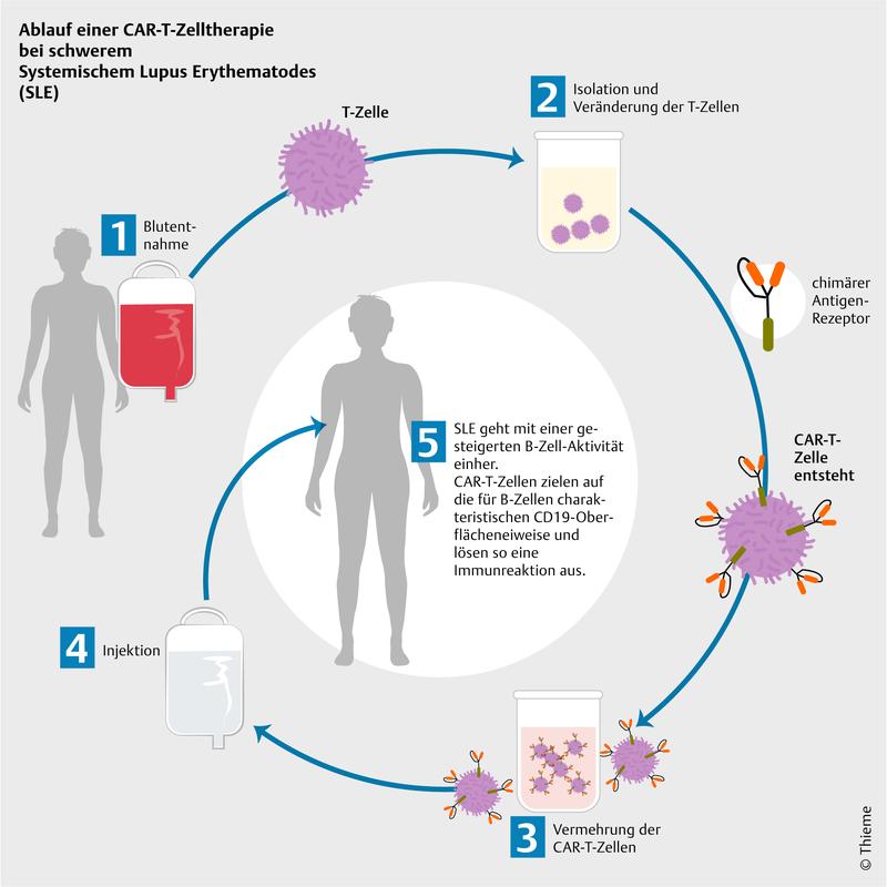 Ablauf einer CAR-T-Zelltherapie bei schwerem Systemischem Lupus Erythematodes (SLE)