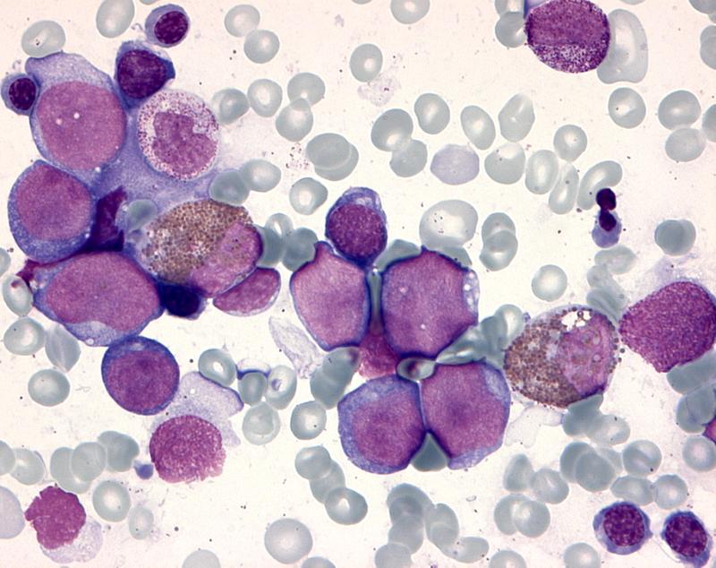 Knochenmarkausstrich eines Kindes mit Down-Syndrom, das an einer Leukämie erkrankt ist. Die violett gefärbten unreifen Leukämiezellen (Blasten) verdrängen die normale Blutbildung.