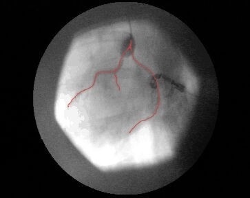 Konventionelle Koronarangiographie