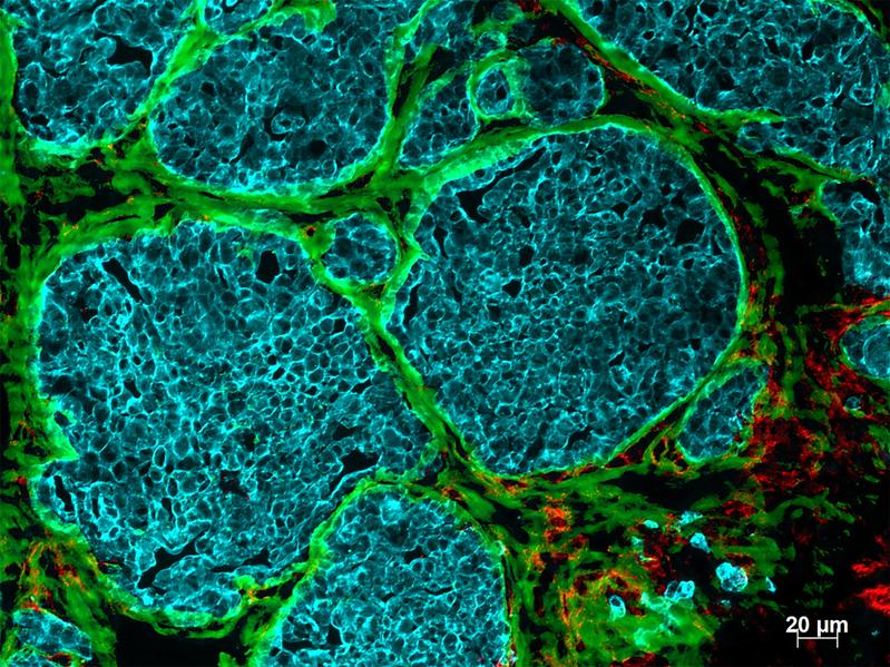 Gewebeschnitt eines Brusttumors einer Maus: Matrix-​Kanäle (grün) teilen das Tumorgewebe (blau) und bilden Nischen für Immunzellen (rot), die so die Tumorzellen nicht mehr erreichen und töten können. 