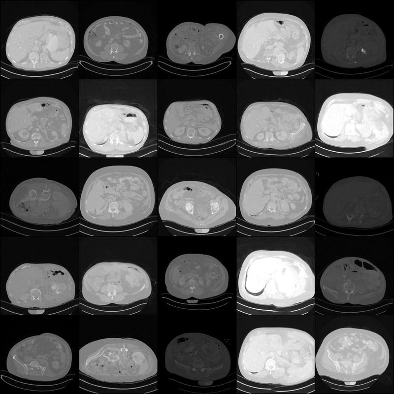 Erste Trainingsergebnisse: Aus zahlreichen echten Patientendaten wurden erste synthetische CT-Aufnahmen vom Abdomen erstellt. 