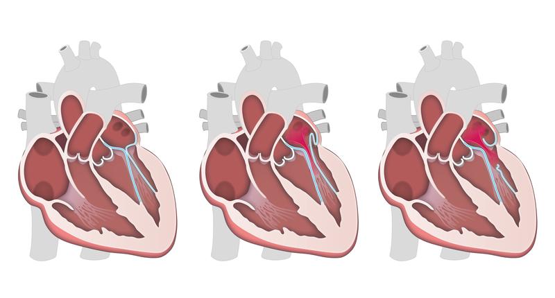 Mitral valve prolapse (center and right) compared to a healthy valve. 