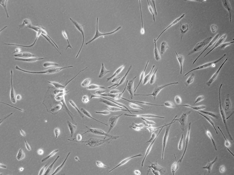 Frisch isolierte Glioblastomzellen eines Patienten in der Zellkultur (400-fache Vergrößerung)