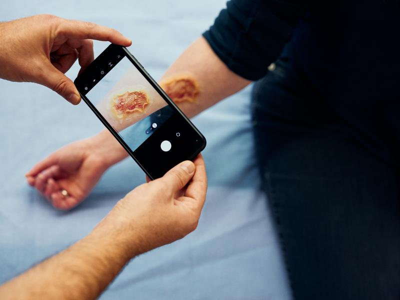 Mittels eines Smartphones wird die Wunde gescannt. Die KI gibt eine Einschätzung und Behandlungsempfehlungen. 
