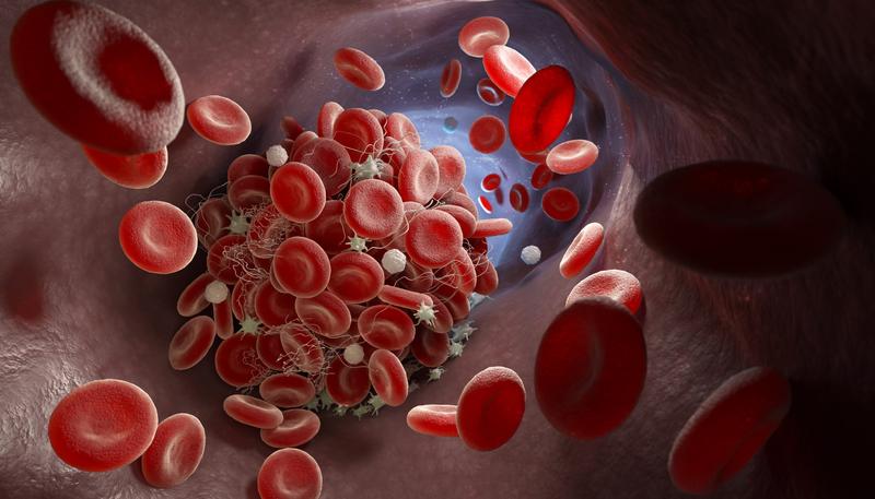 Schematic illustration of the formation of a blood clot in a vein.