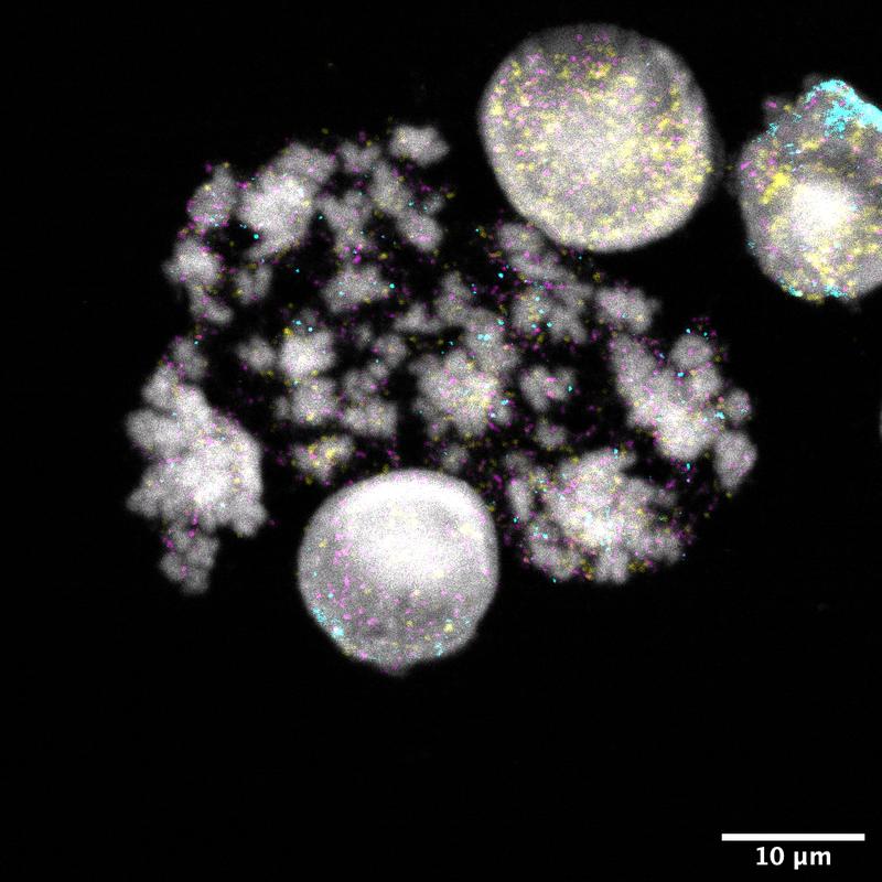 Kerne und Chromosomen von Neuroblastomzellen. DNA-Ringe sind gelb, türkis oder magenta angefärbt. Jede Farbe signalisiert unterschiedliche Krebsgene.