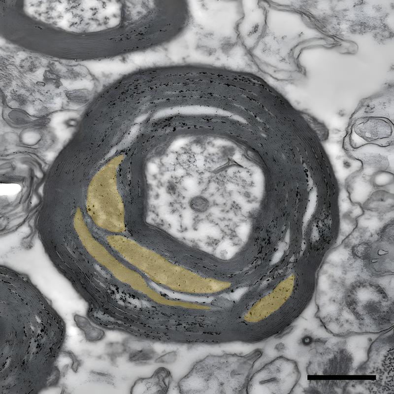 Die Abbildung zeigt die elektronenmikroskopische Aufnahme einer myelinisierten Nervenfaser im Sehnerv eines MS-Betroffenen. Es ist zu erkennen, dass die Myelinscheide aufgelockerte Bereiche (in gelb) enthält. Der schwarze Balken entspricht 0,5 Mikrometern.