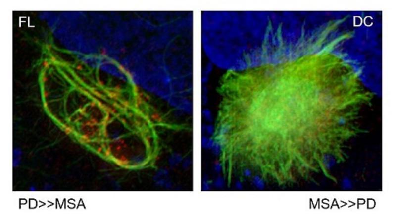Zellkulturen, in denen alpha-Synuclein (grün) filamentös erscheint (links), die wahrscheinlicher zu einer Parkinson-Krankheit führen, im Vergleich zu alpha-Synuclein mit dichtem Kern (rechts), die wahrscheinlicher zu einer Multisystematrophie (MS) führt.