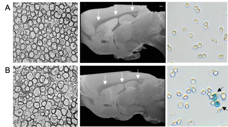 (v.l.) Elektronenmikroskopische Aufnahme der weißen Substanz; MRT-Aufnahme sowie lichtmikroskopische Aufnahmen von Oligodendrozyten aus gesundem Mausgehirn (A) und nach Aktivierung des Genregulators NF-κB (B)