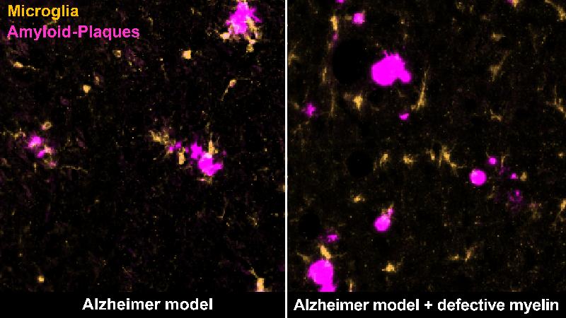 Certain immune cells, microglia (yellow), remove amyloid plaques (magenta) in the brain of an Alzheimer mouse (left). Degenerating myelin distracts them from doing so (right).