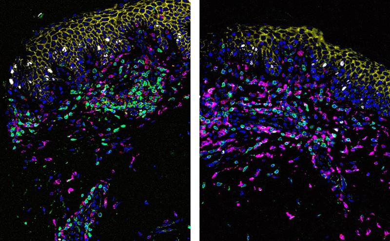 Hautschnitte eines Studienpatienten vor und nach DMF-Therapie. Die Fluoreszenzfärbung zeigt die typischen, durch die Behandlung hervorgerufenen Veränderungen auf Zellebene. NF-kB-Aktivität (hellblau) und T-Zellen (weiß) nehmen ab, Makrophagen (rosa) zu.