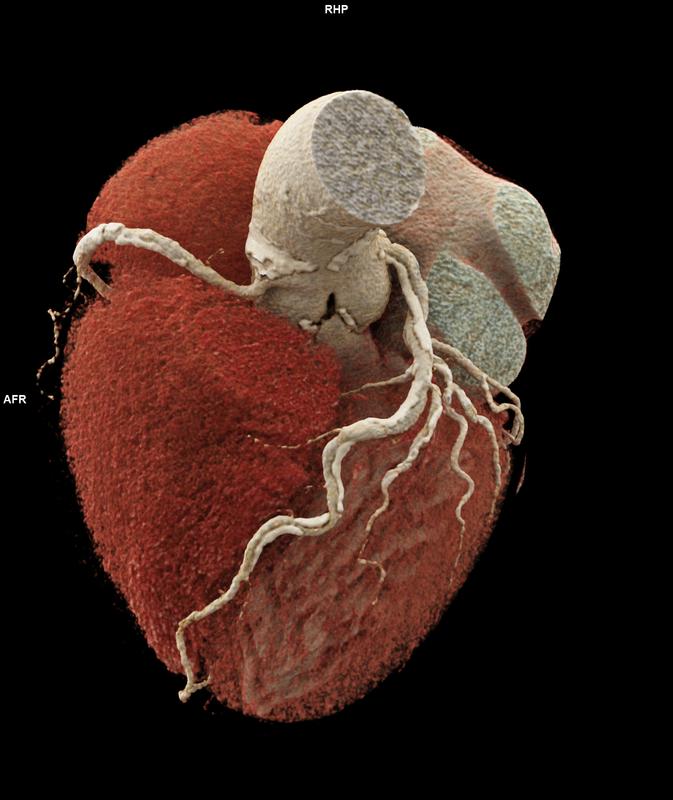 Photon-Counting-CT des Herzens. Trotz sehr schwerer Verkalkungen an den Gefäßwänden (3D-Aufnahme), gelingt eine diagnostische Darstellung, die zeigt, dass die Gefäße nicht verstopft sind. Ein Herzkathetereingriff ist in diesem Fall nicht nötig.